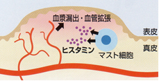 薬 蕁 麻疹 飲み